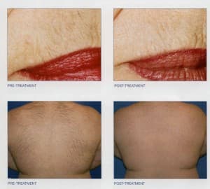 Laser Hair Removal Before & Afters