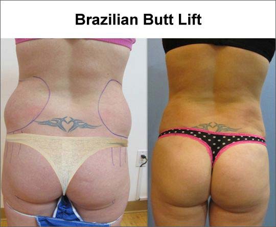 Brazil Butt Lift, Brazil Butt Lift Diet