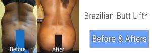 Brazilian Butt Lift Before and Afters in Palm Beach Gardens