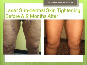 Liposuction for Cellulite Reduction
