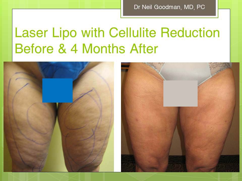 Cellulite Reduction/Laser Liposuction Results