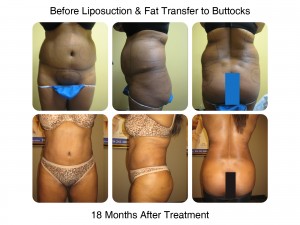 Brazilian Butt Lift Procedure - Before and After