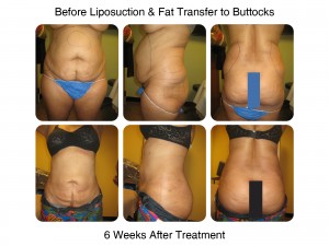 Lipo and Fat Transfer to Butt - 6 Weeks After