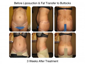 Before Liposuction & Fat Transfer to Buttocks - 3 Weeks After