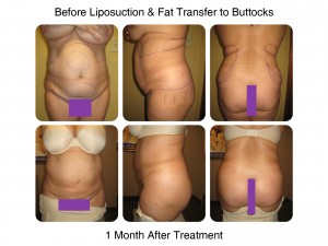 Brazilian Butt Lift Procedure - 1 Month After Treatment