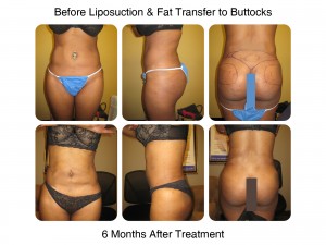 Brazilian Butt Lift Procedure - Before and After