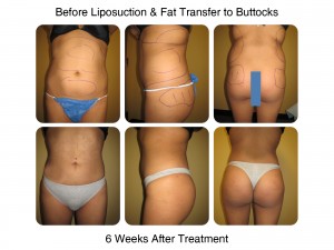 Fat Transfer to Butt Example