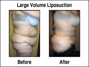 Large Volume Liposuction - Before and After
