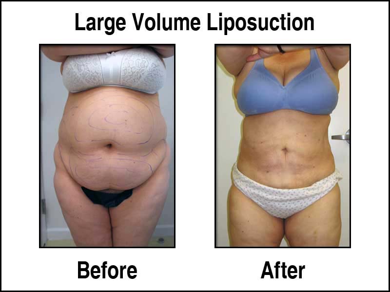 Large Volume Liposuction Results