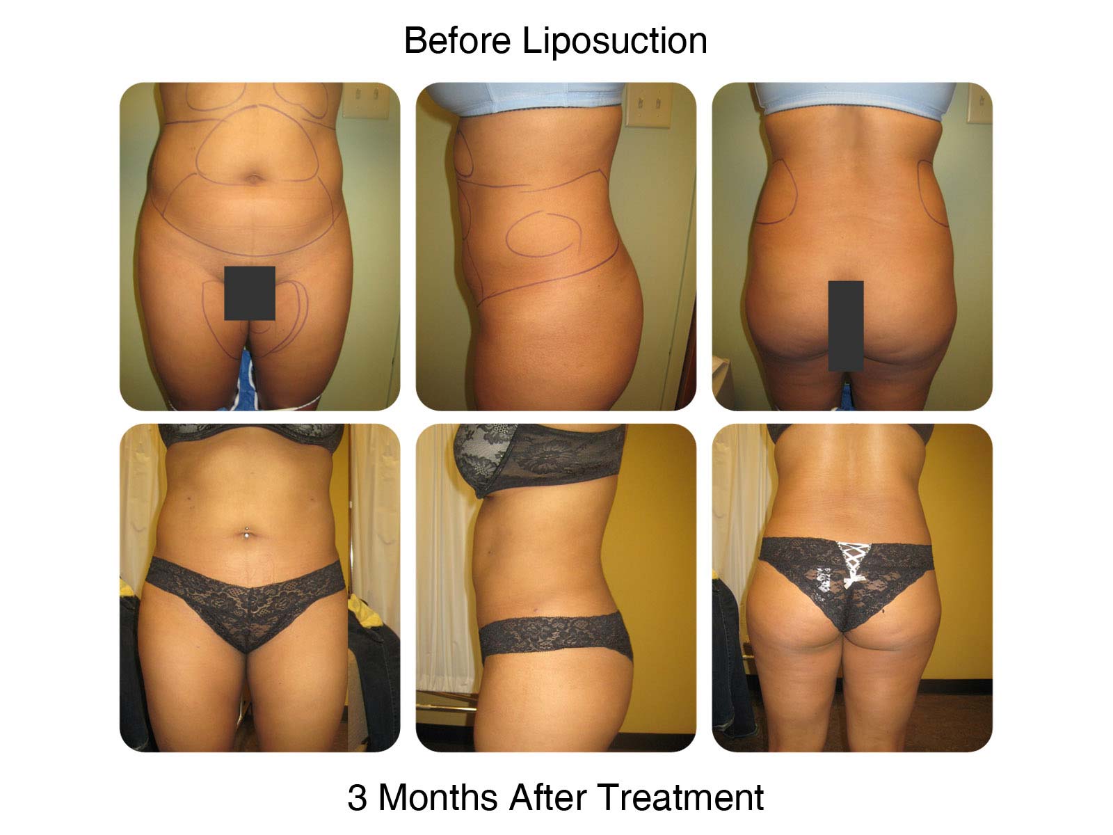 Liposuction - Before and 3 Months After