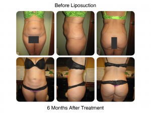 Liposuction 6 Months After