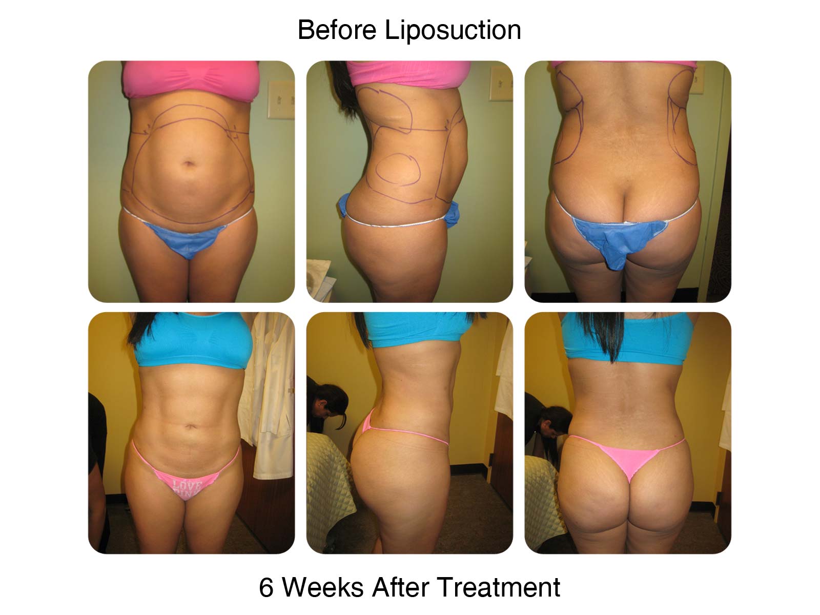 6 Weeks After - Lipo Results