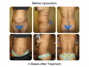 Liposuction Procedure at New Radiance