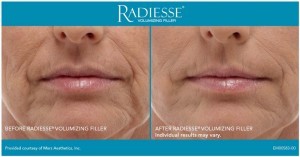 Radiance for Front Smile Lines - Before and After
