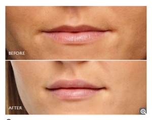 Restylane Lip Enhancement - Before & After
