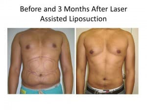 liposuction for men