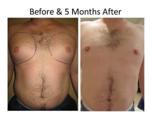 Male Breast Reduction 2