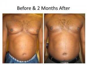 Male Breast Reduction 4