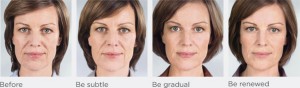 sculptra before after 2
