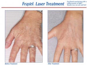 Fraxel hands - Before and After