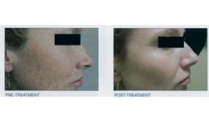 Intense Pulsed Light - Before and After