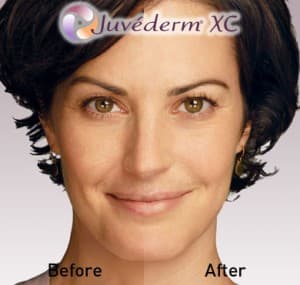 Juvederm Before After 3