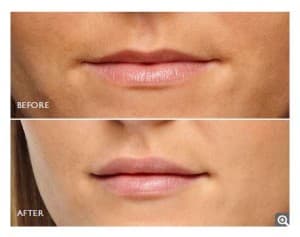Lip Enhancement - Restylane