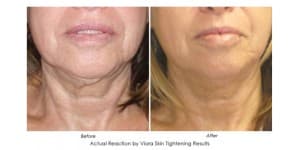Viora face - Before and After 2