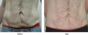 Viora Body - Before and After 5