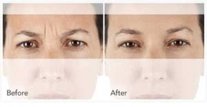 xeomin BeforeAfter 1