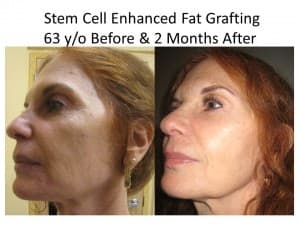 liposuction and fat transfer to face
