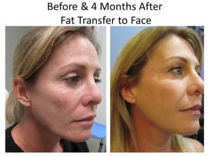 fat transfer to face after liposuction