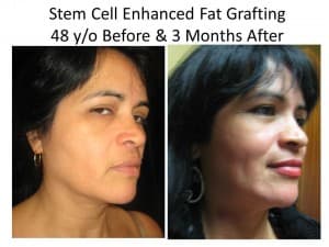 stem cell facelift