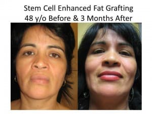 fat transfer to face