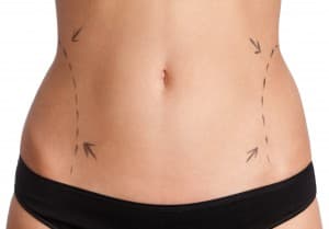 Top Liposuction Questions Asked