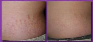 Stretch Mark Before and After