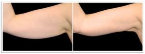 Exilis Ultra Arms Before and After