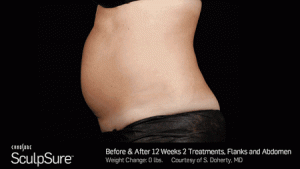 Sculpsure Abdominal before and after