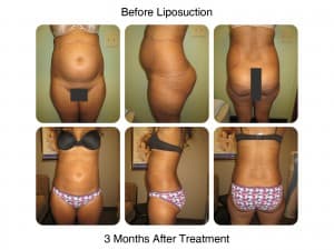 Liposuction before and after 3 month