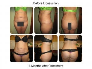 Lipo And Fat Transfer woman before and after