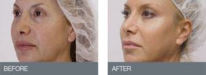 thread lift before & after 2