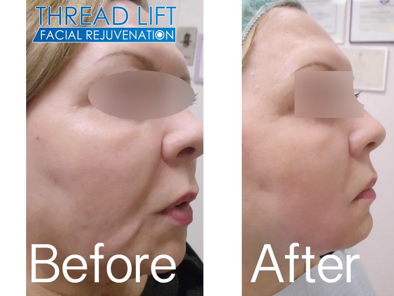 Non Surgical Face Lift New Radiance Cosmetic Center of Palm Beach