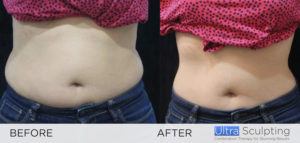 Ultra Sculpting Female Abs before and after 1