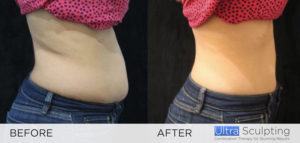 Ultra Sculpting Female Abs before and after 3