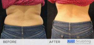 Ultra Sculpting Female flanks fat reduction before and after