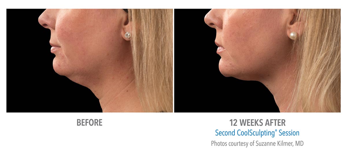 CoolSculpting for Chin, Neck and Jawline New Radiance Cosmetic