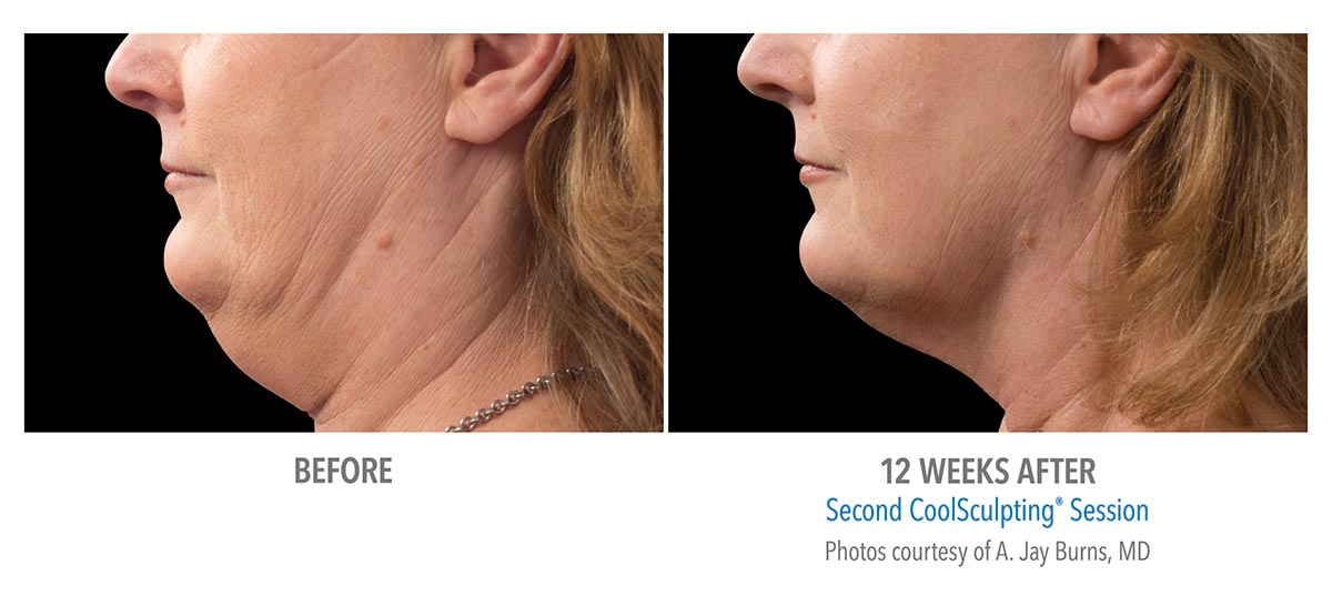 CoolSculpting for Chin, Neck and Jawline - New Radiance Cosmetic ...