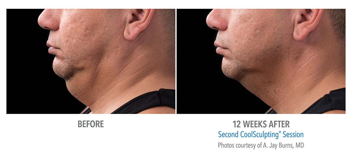 CoolSculpting for Chin, Neck and Jawline - New Radiance Cosmetic ...