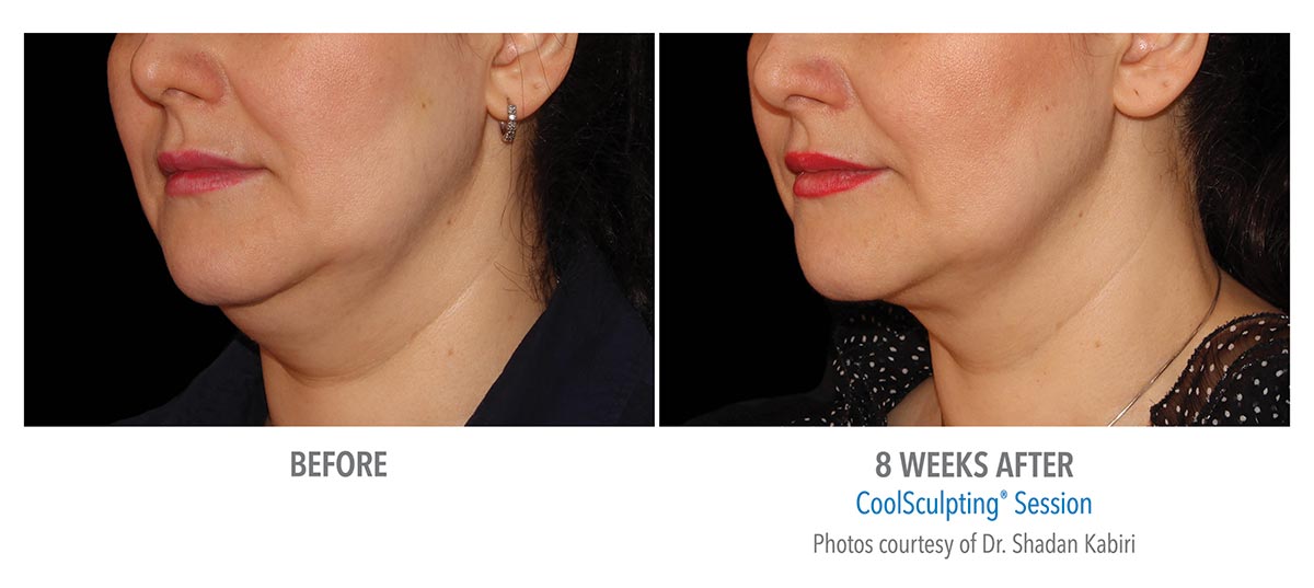 CoolSculpting for Chin, Neck and Jawline - New Radiance Cosmetic ...