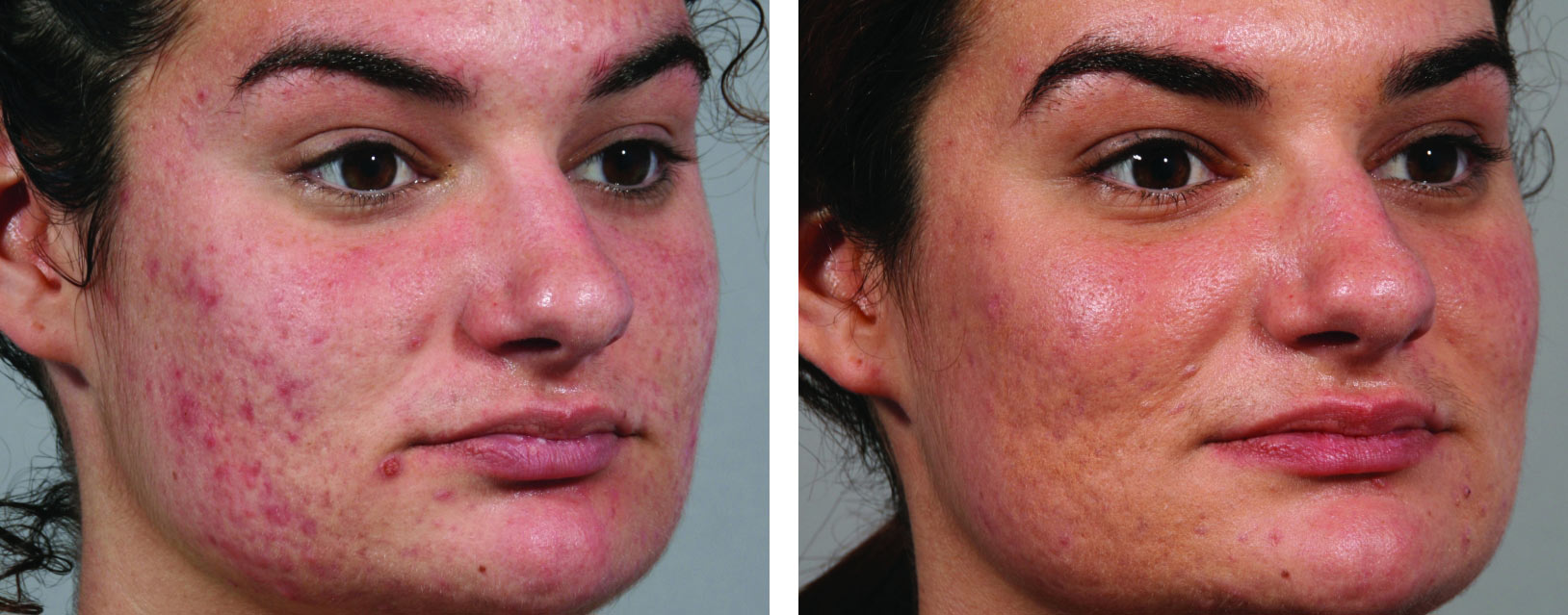 intensif-microneedling-for-acne-scars-by-endymed